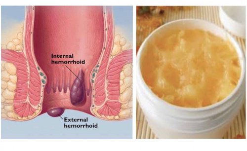 NATURAL RECIPE PROVEN TO ELIMINATE HEMORRHOIDS FOREVER